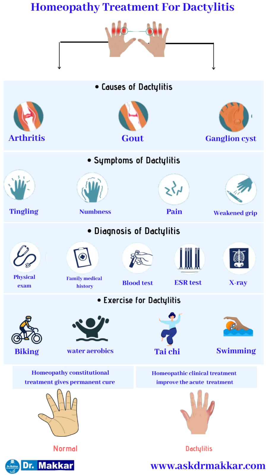 dactylitis-sausage-fingers-digit-swelling-of-fingers-toes